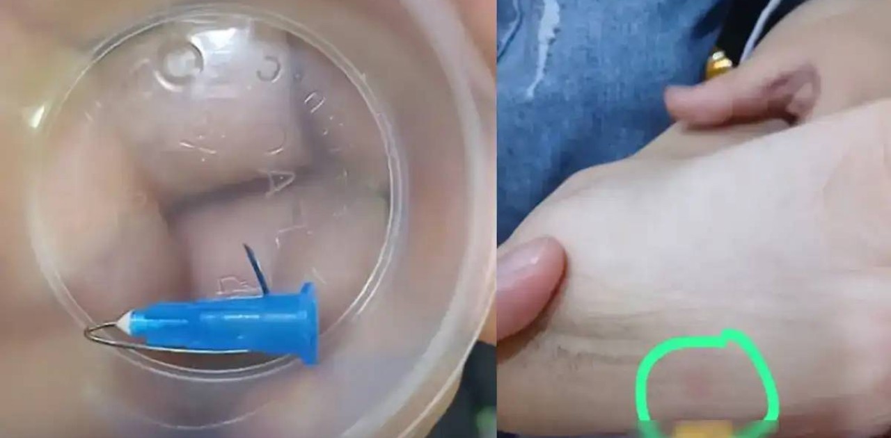 «Енді 6 ай дәрігерге апаруым керек»: Астанадағы кафеде баланың аяғына медициналық шприц кіріп кеткен