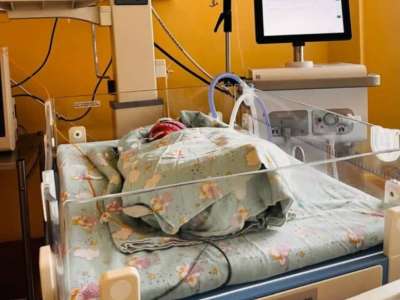 Шымкентте шала туған нәрестеге бір уақытта күрделі екі ота жасалды